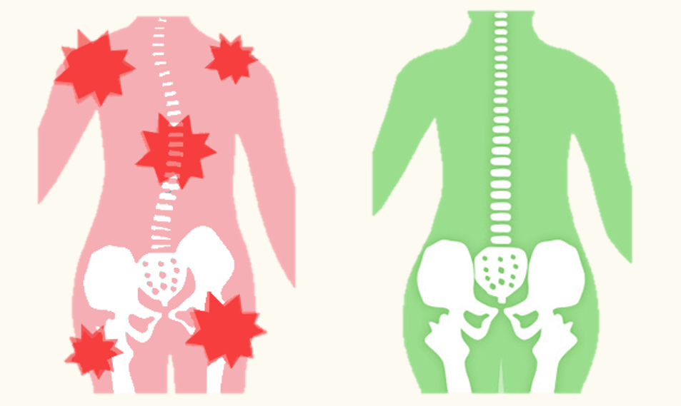 歪んだ背骨、骨盤は首こり、肩こり、腰痛など体に痛みがでやすい